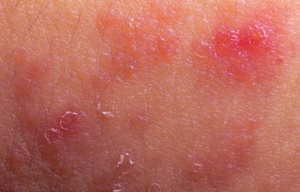 Pele avermelhada e inflamada