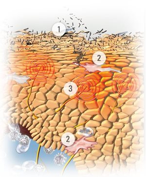 Ilustração da pele com sintomas de Dermatite Atópica